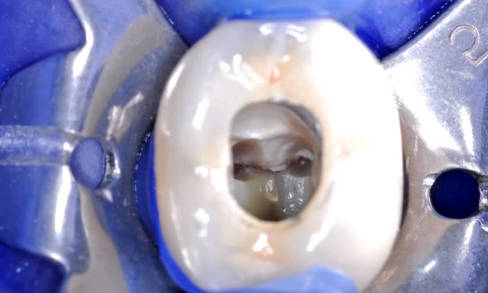 Mandibular Molar with 5 Root Canals