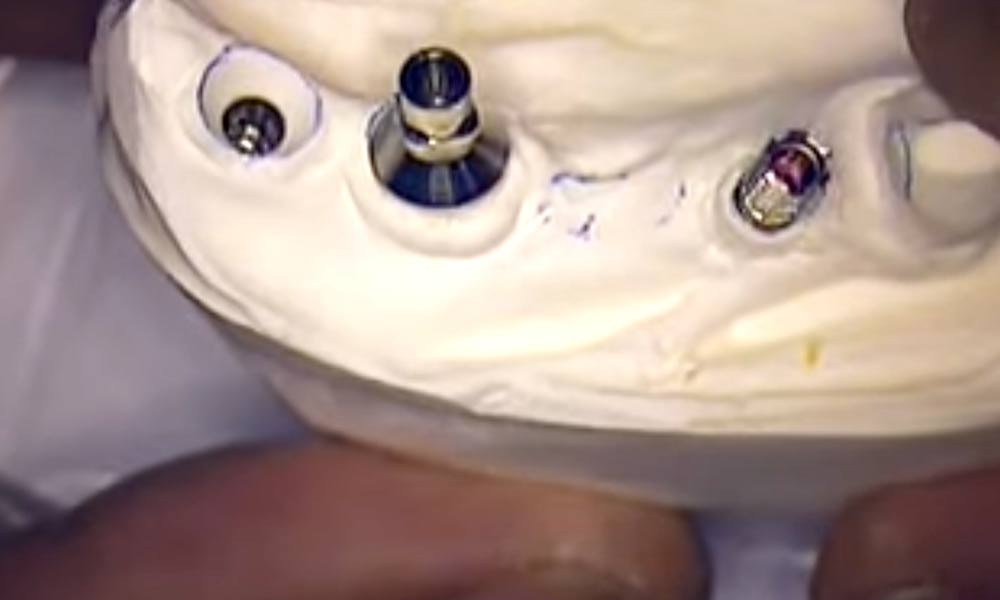 Implant work 5 Trimming the temporary abutments to fit the model