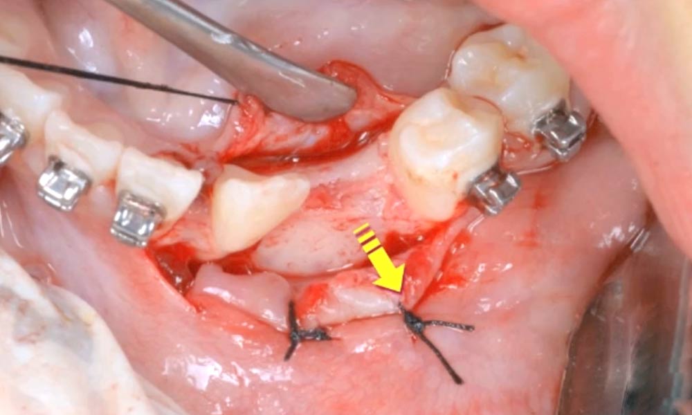 CBCT & Impacted cuspids-3